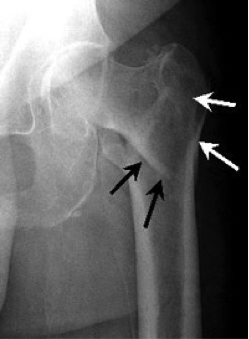 Hip inter trochanteric fracture, PJS Orthopaedics Melbourne