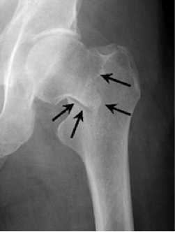 Hip intra capsular fracture, PJS Orthopaedics Melbourne