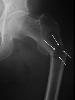 Hip subtrochanteric fracture, PJS Orthopaedics Melbourne