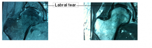 Arthroscopy labreal tear, PJS Orthopaedics Melbourne