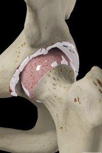 Hip structure figure, PJS Orthopaedics Melbourne
